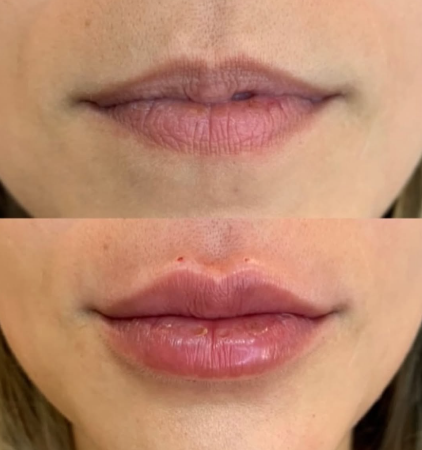Lip care
