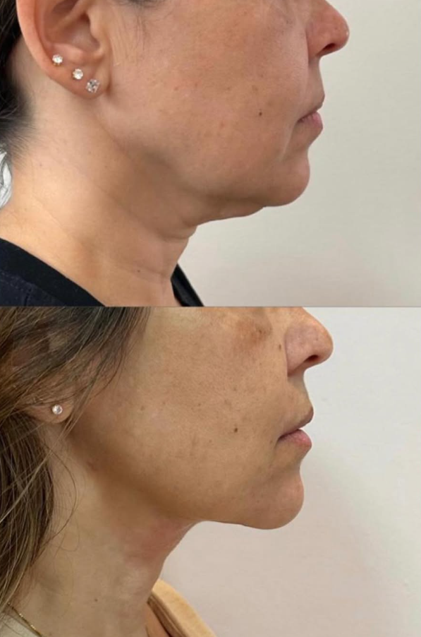 Chin and jaw care